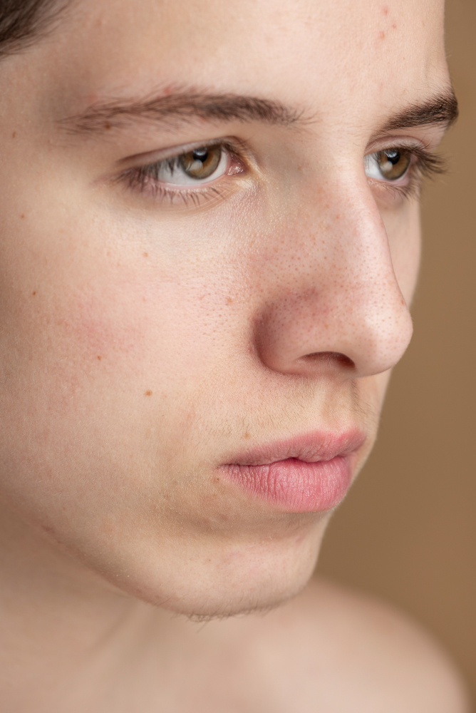 Chemical Peels