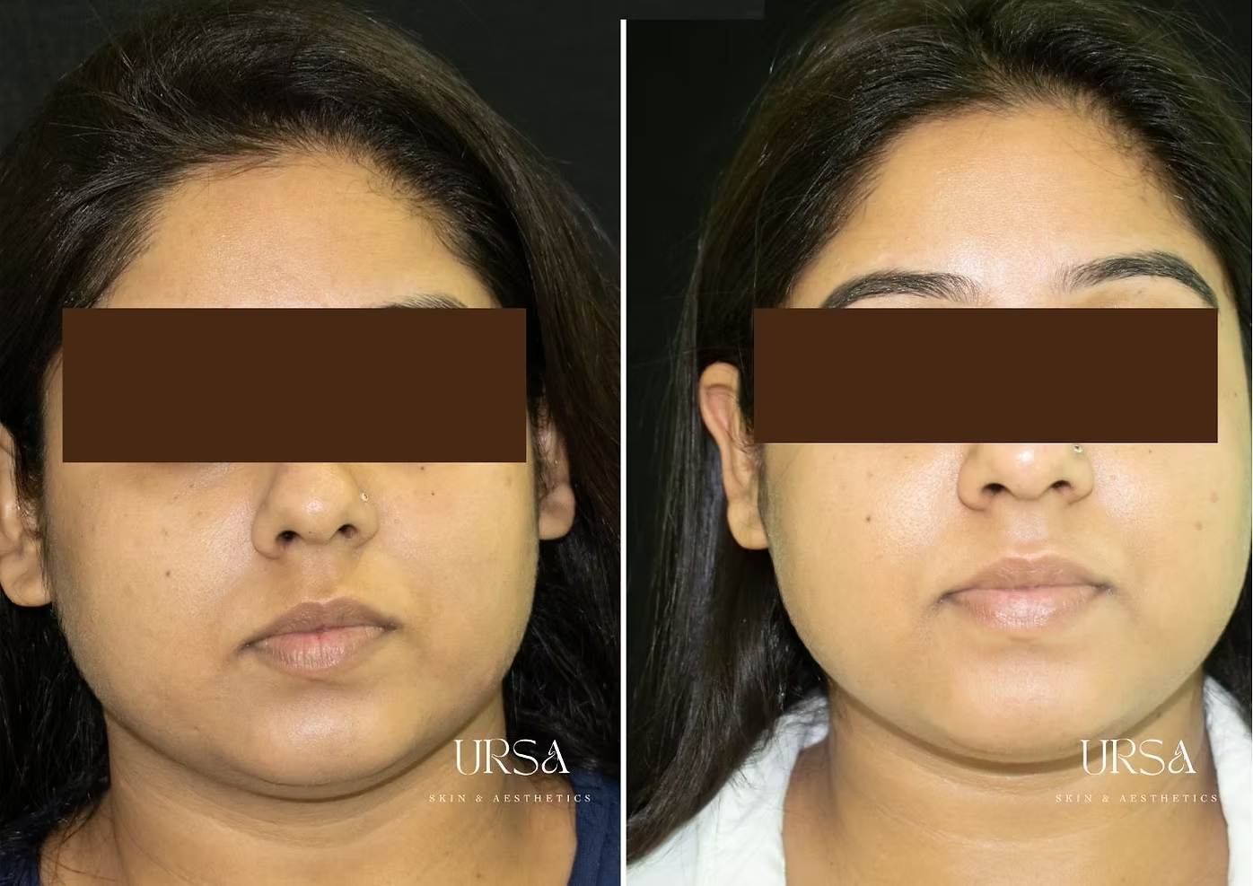 Carbon Glow Facial