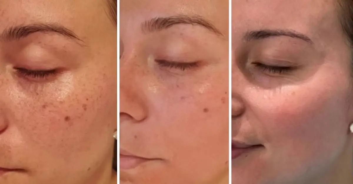 Cosmelan Before After