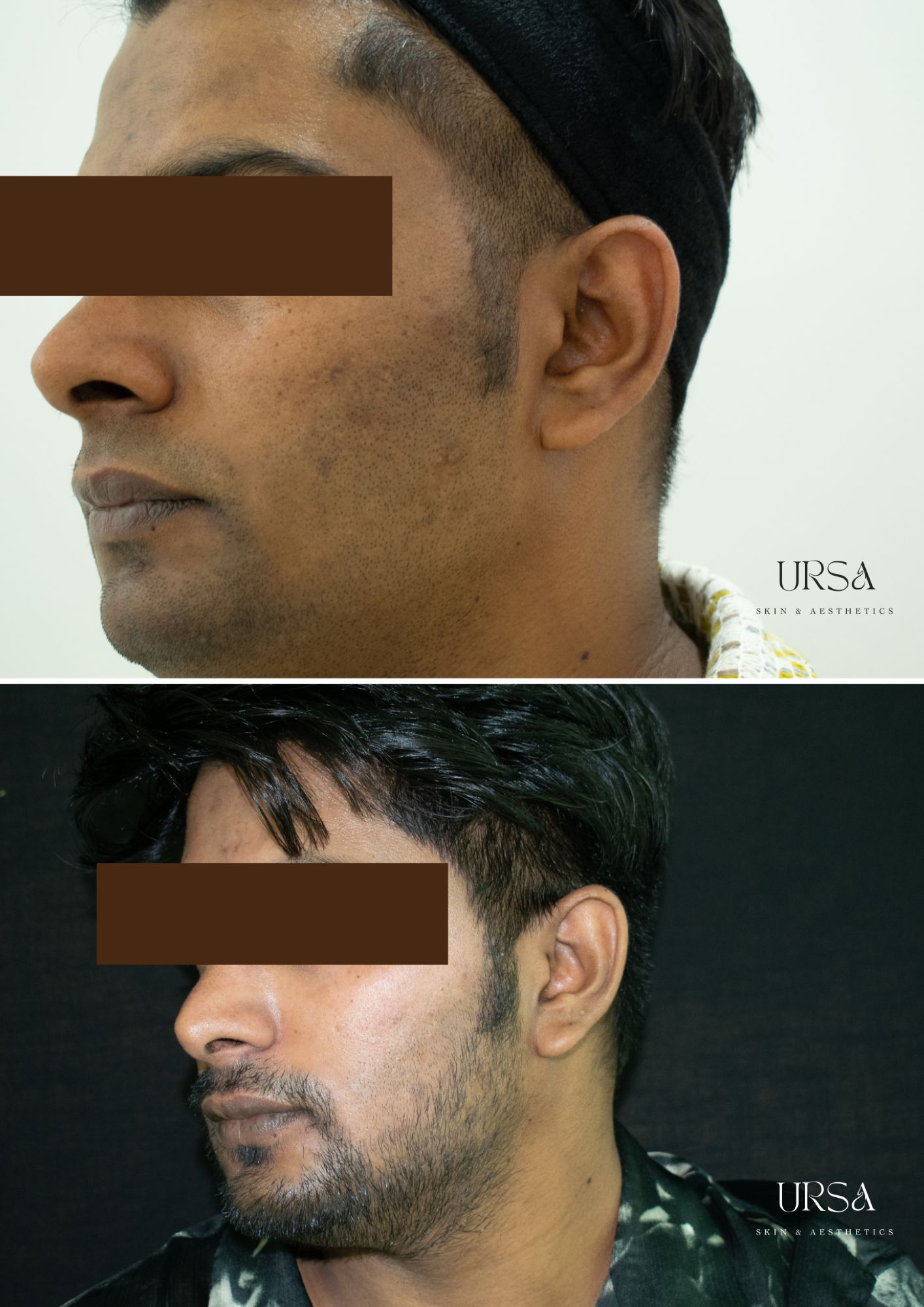 Cosmelan Before After