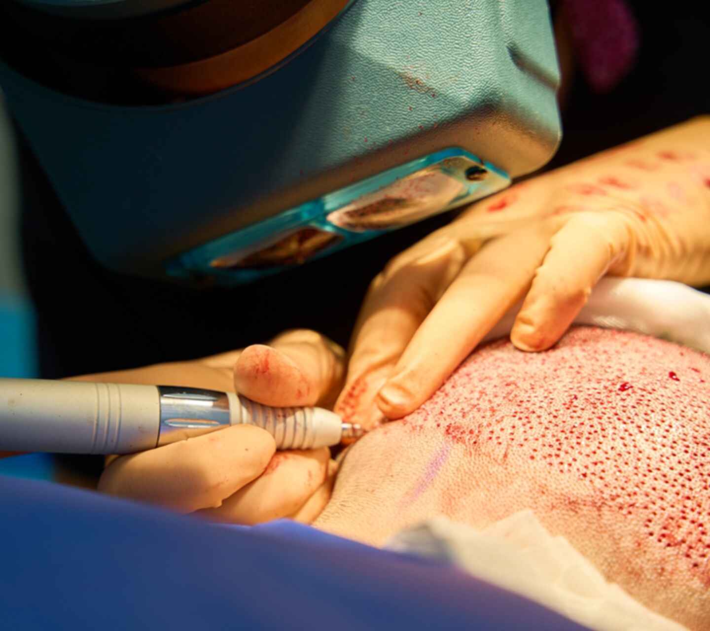 Advanced Hair Transplant (1)