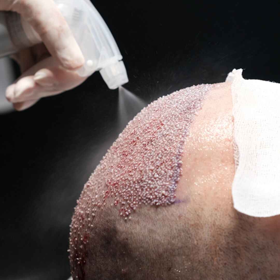 Advanced Hair Transplant (3)