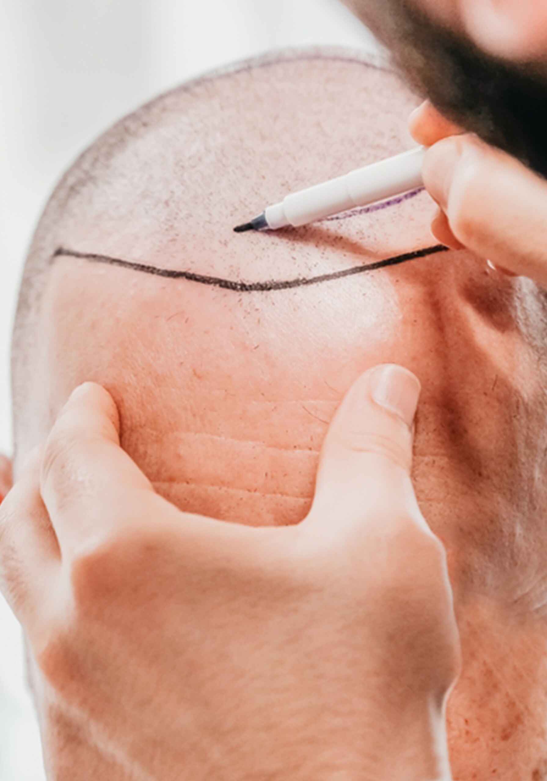 Advanced Hair Transplant (4)