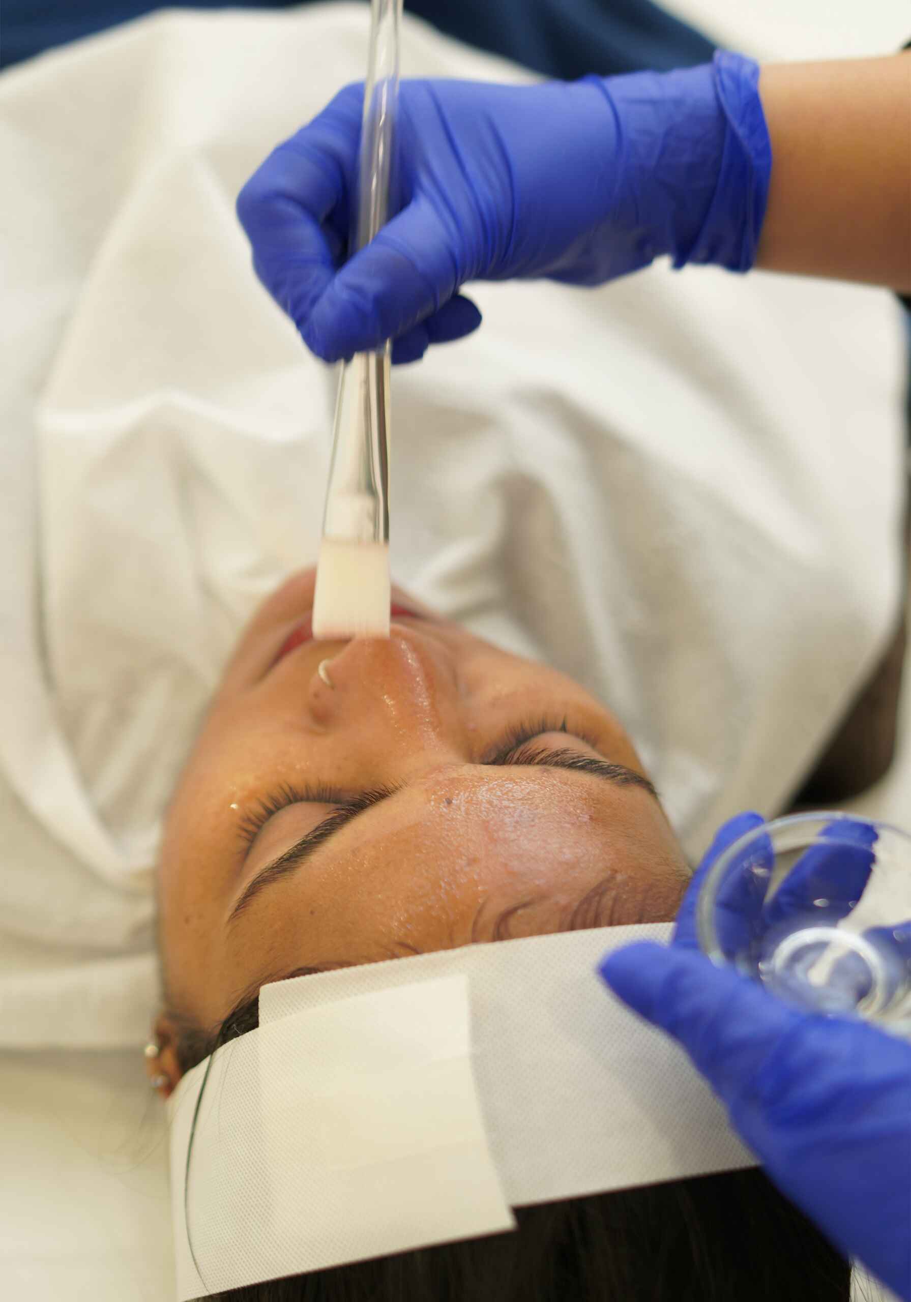 Chemical Peel Treatment (1)