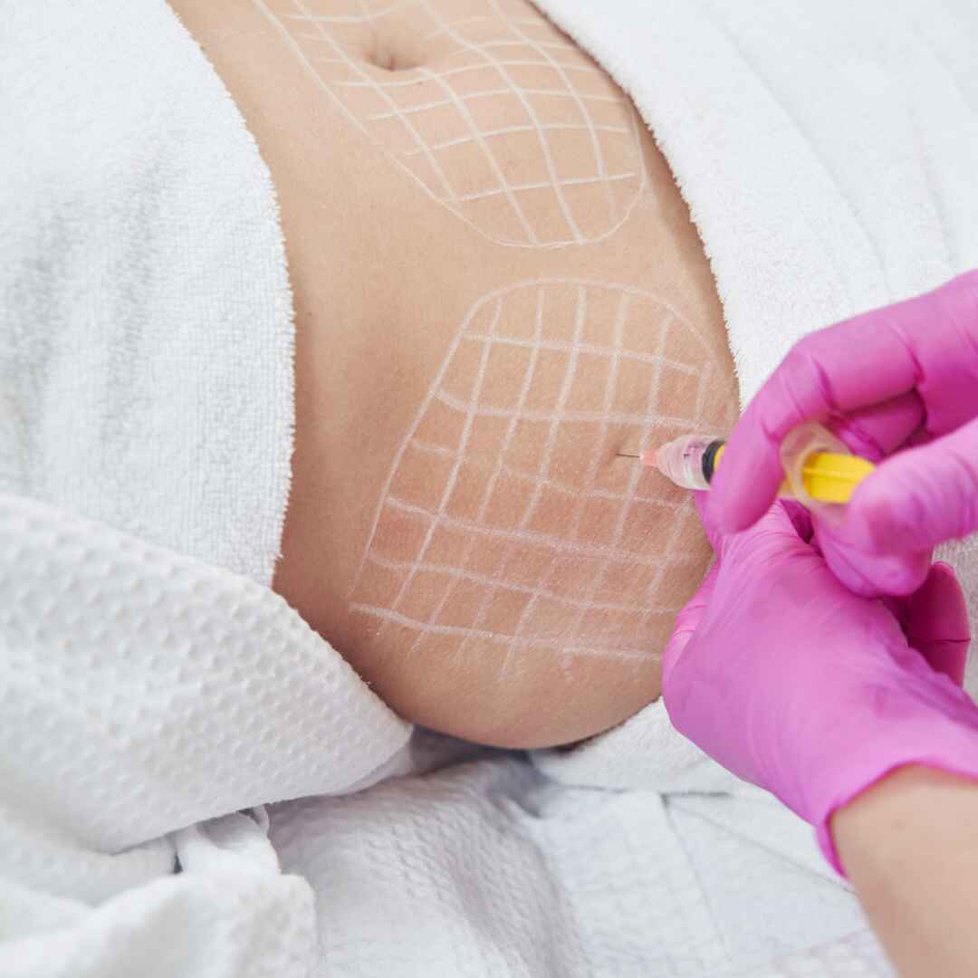 Meso Lipo - Fat Dissolving Injection (3)