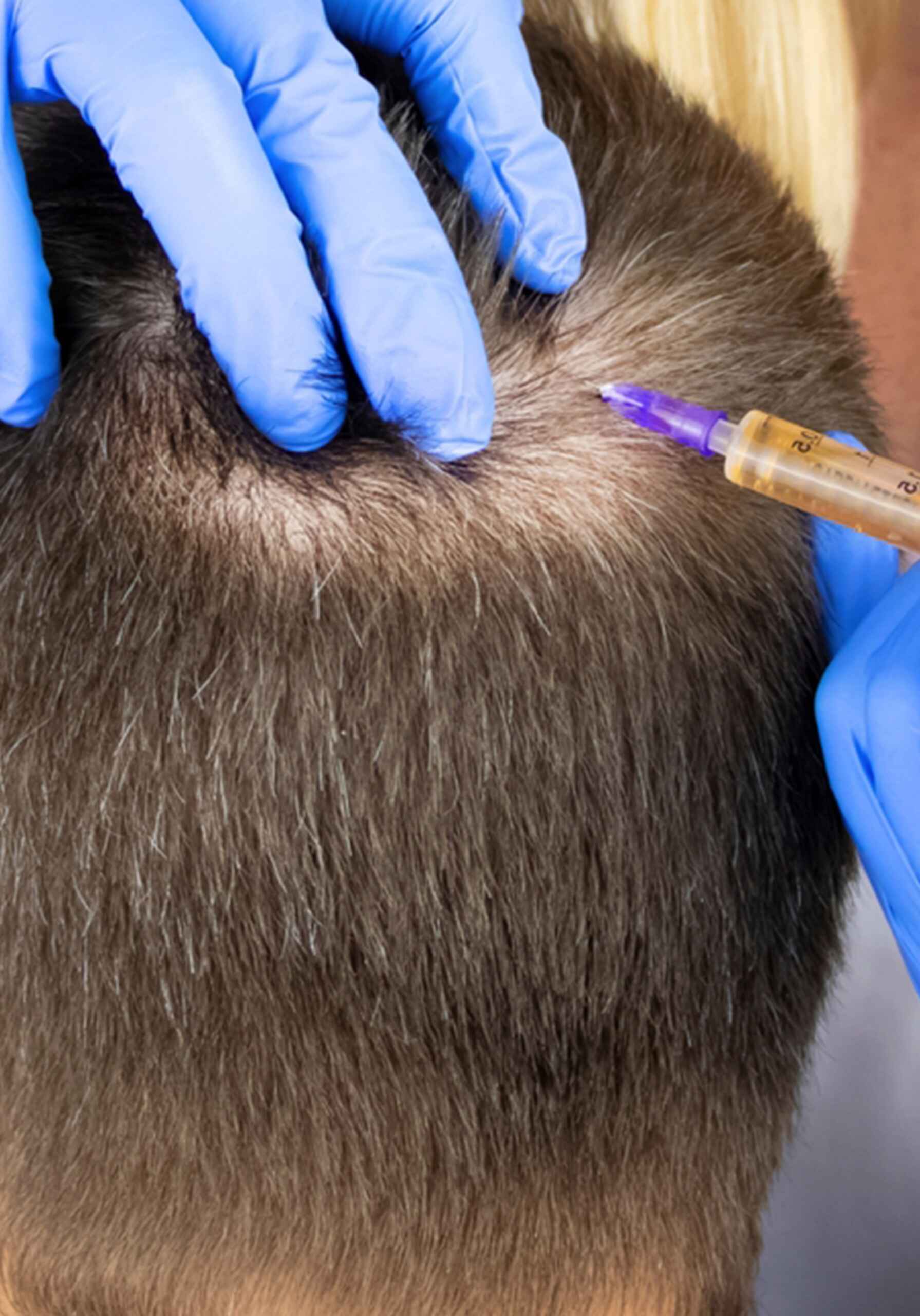 Mesotherapy (1)