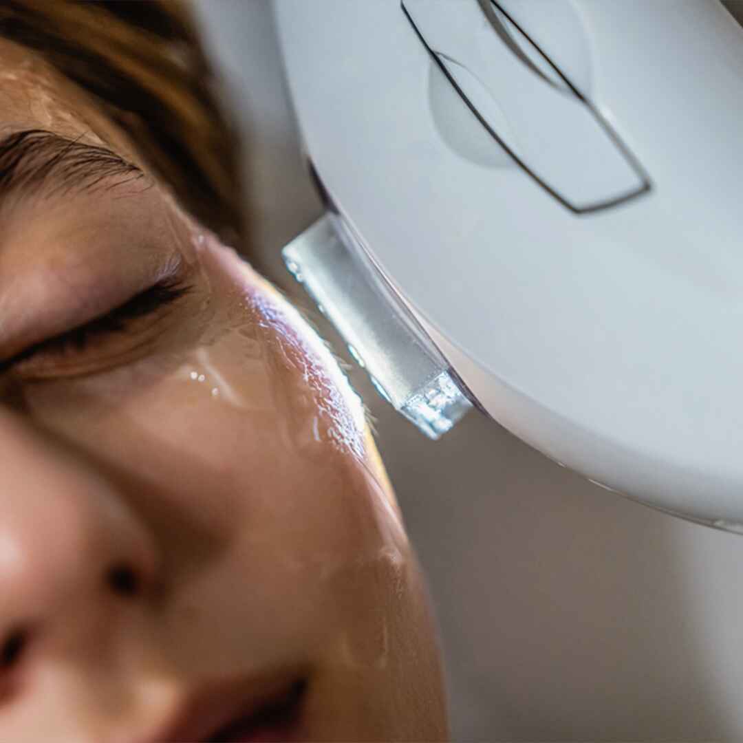 PHOTO FACIAL (IPL) (4)