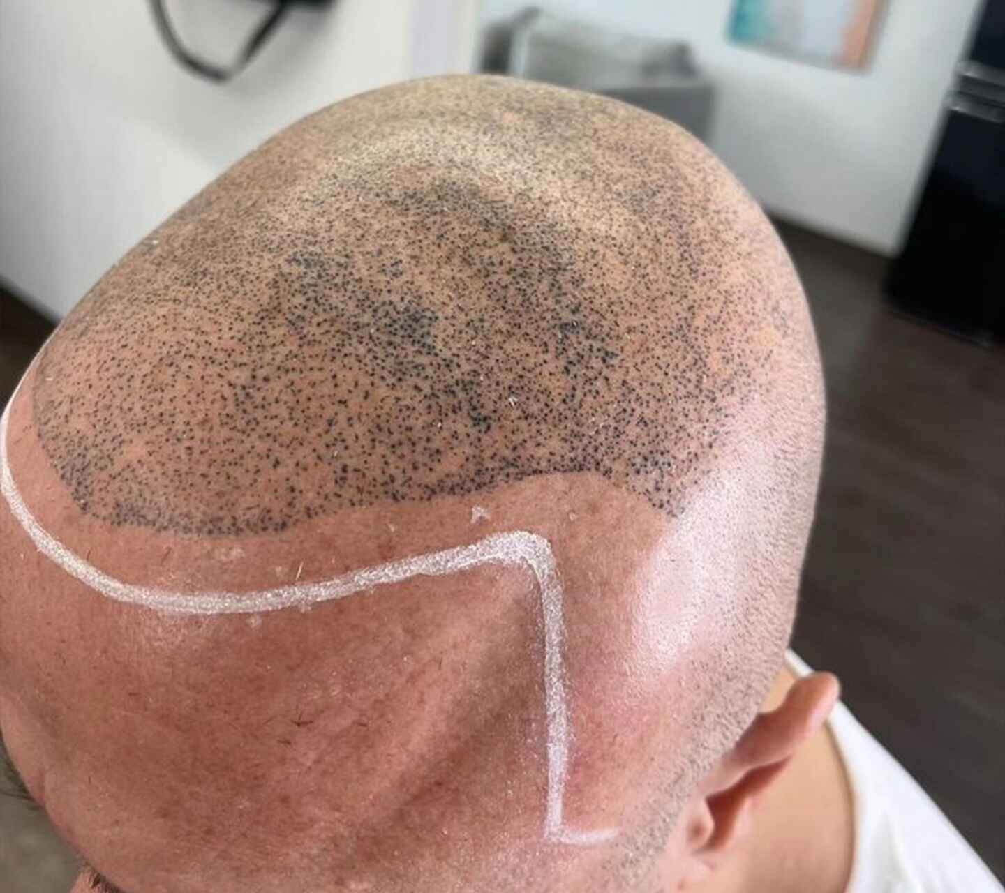 Scalp Micropigmentation (2)