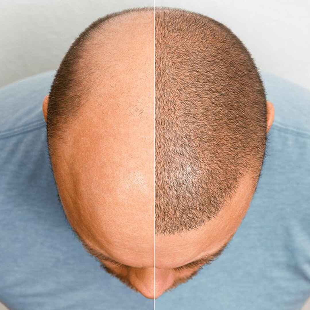 Scalp Micropigmentation (3)