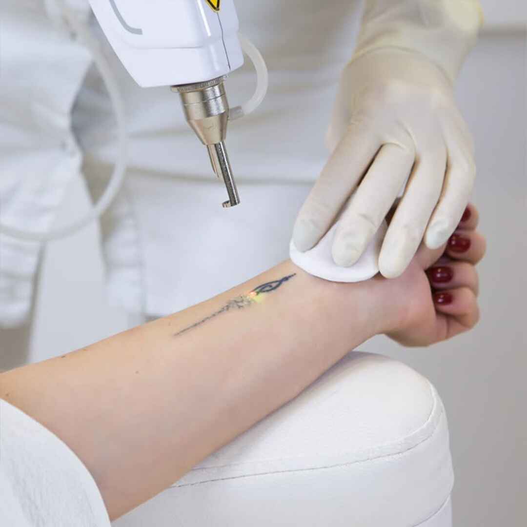Tatto Removal (1)