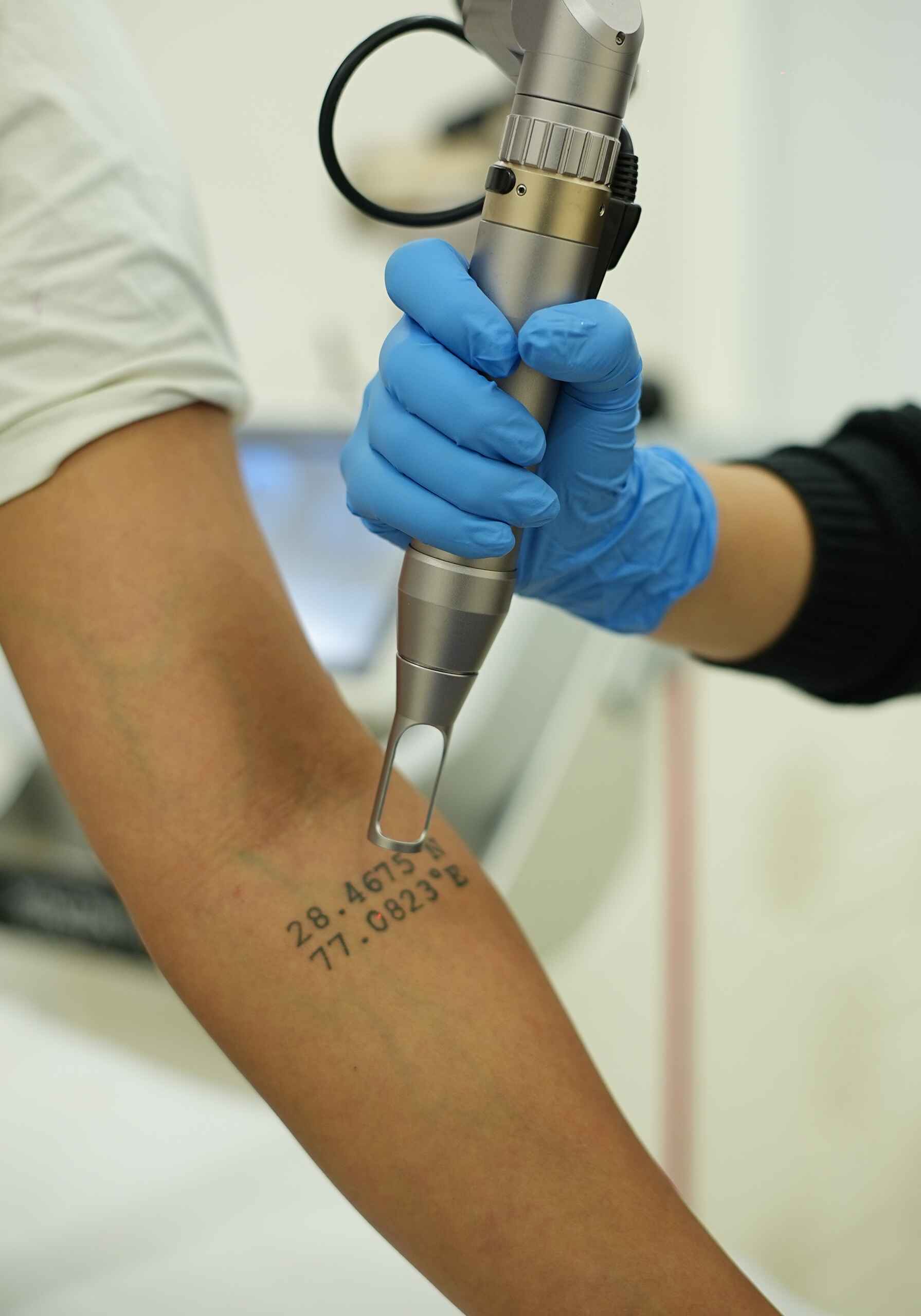 Tatto Removal (2)