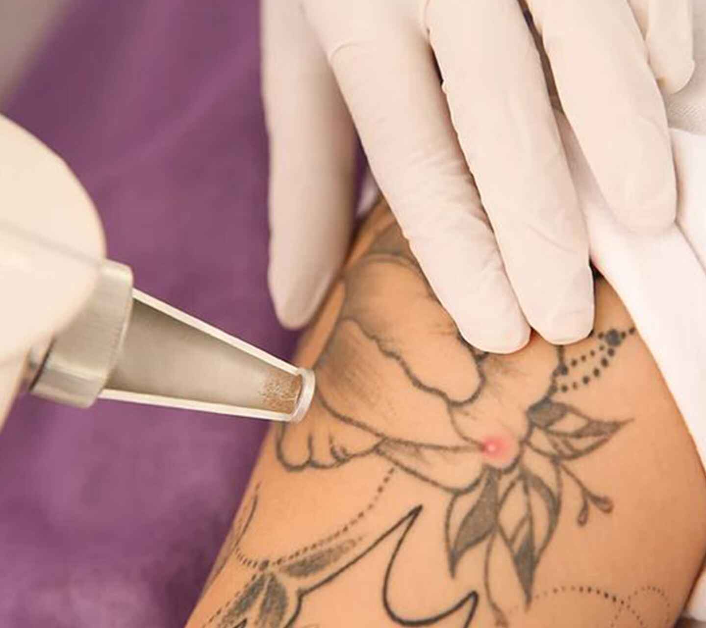 Tatto Removal (3)
