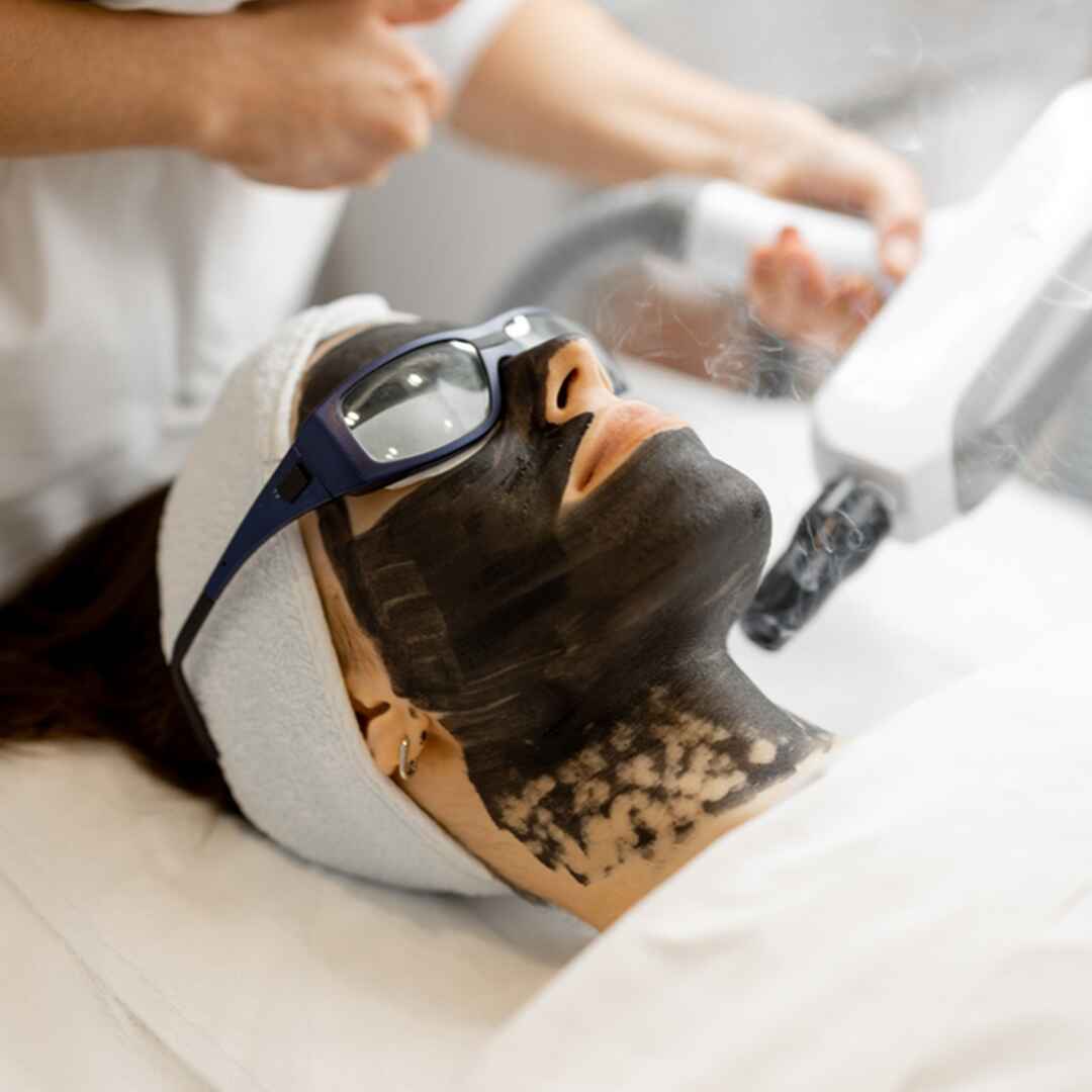 carbon peel facial (2)