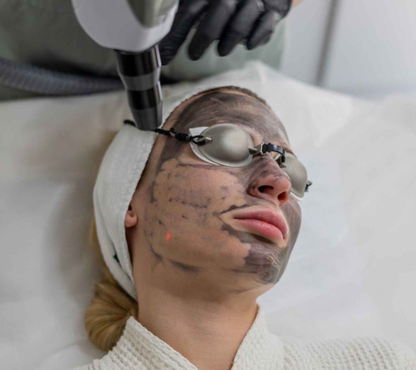 carbon peel facial (3)