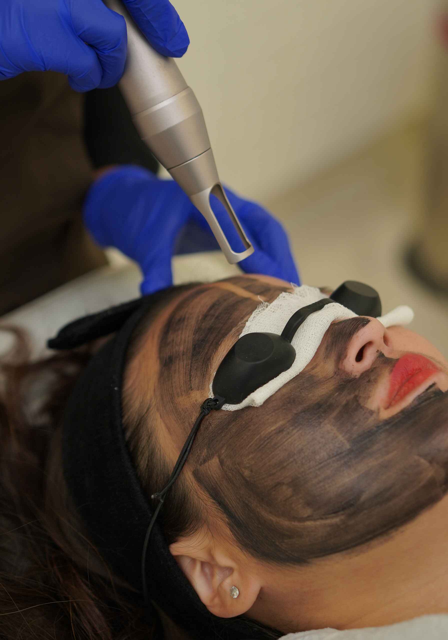 carbon peel facial (4)