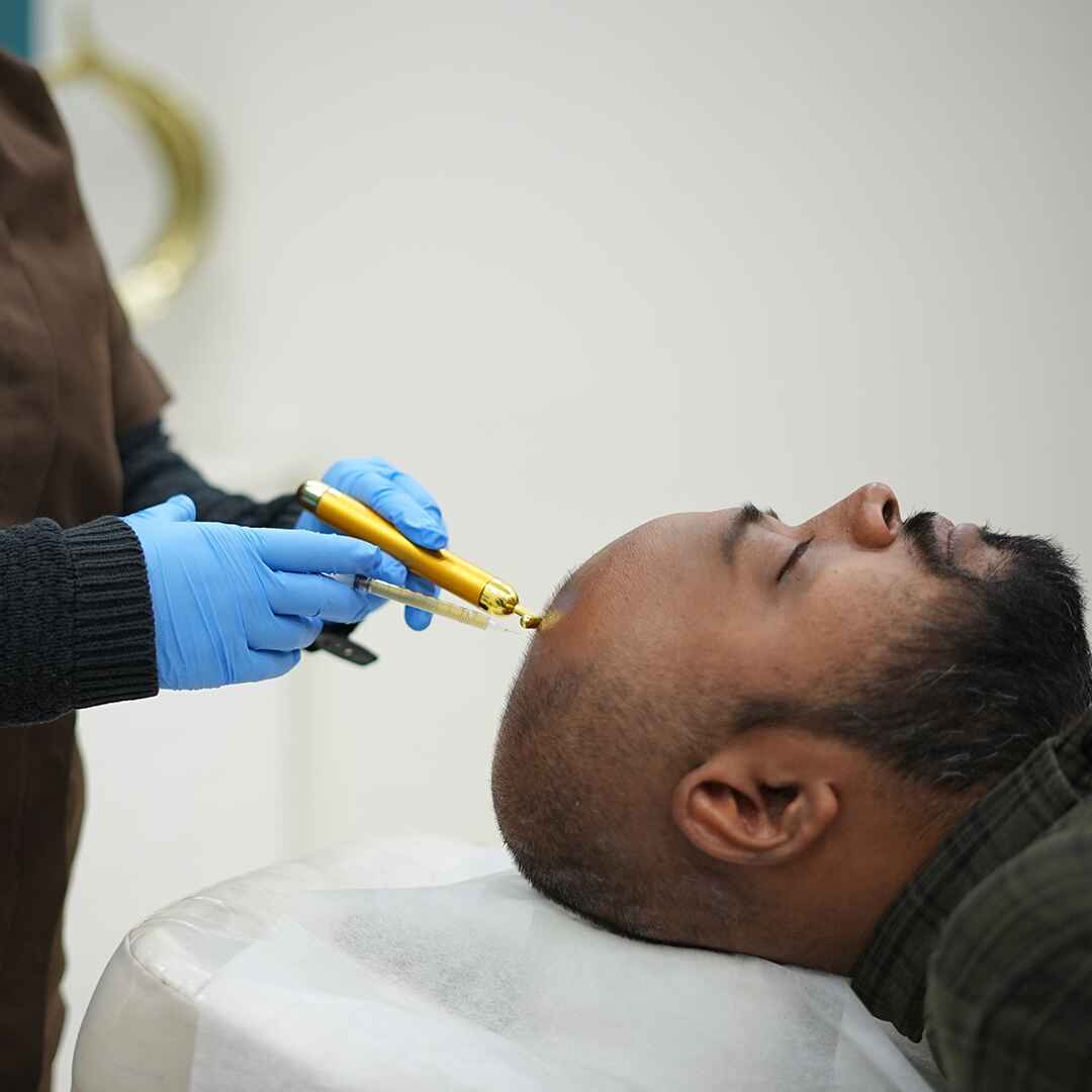 prp hair loss (2)