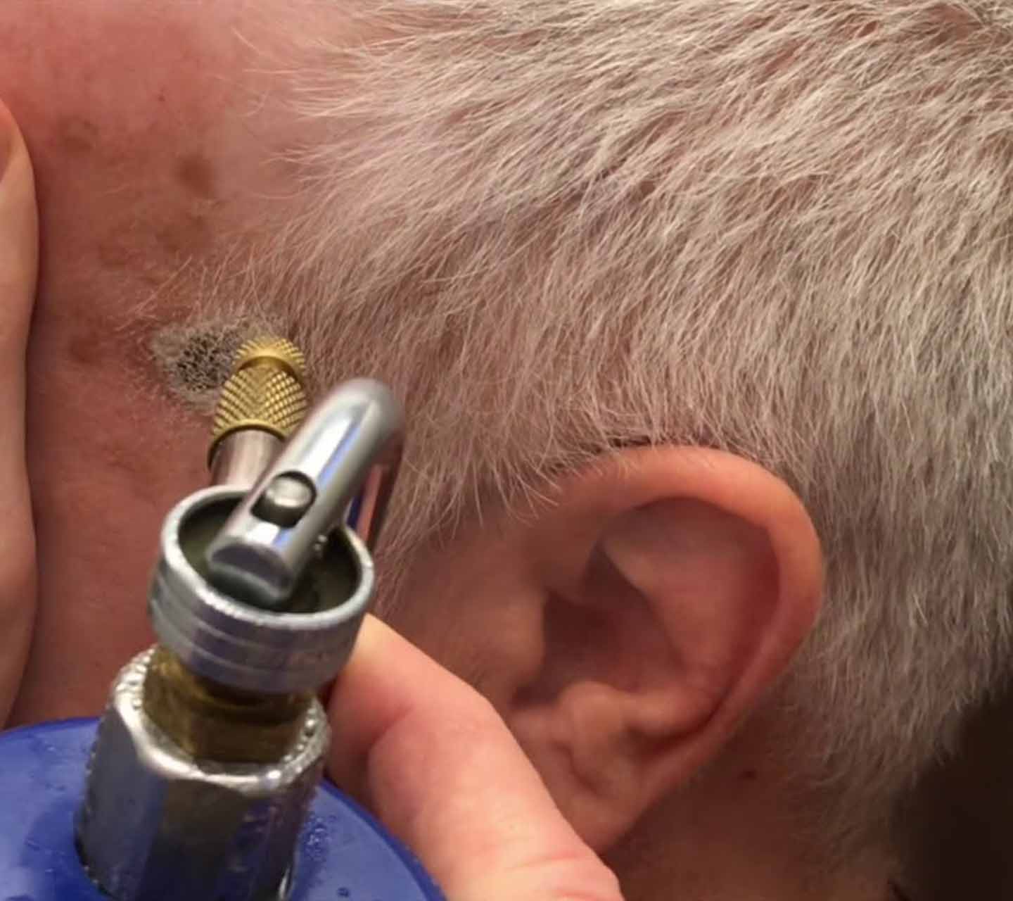 Seborrheic Keratosis Excision (2)