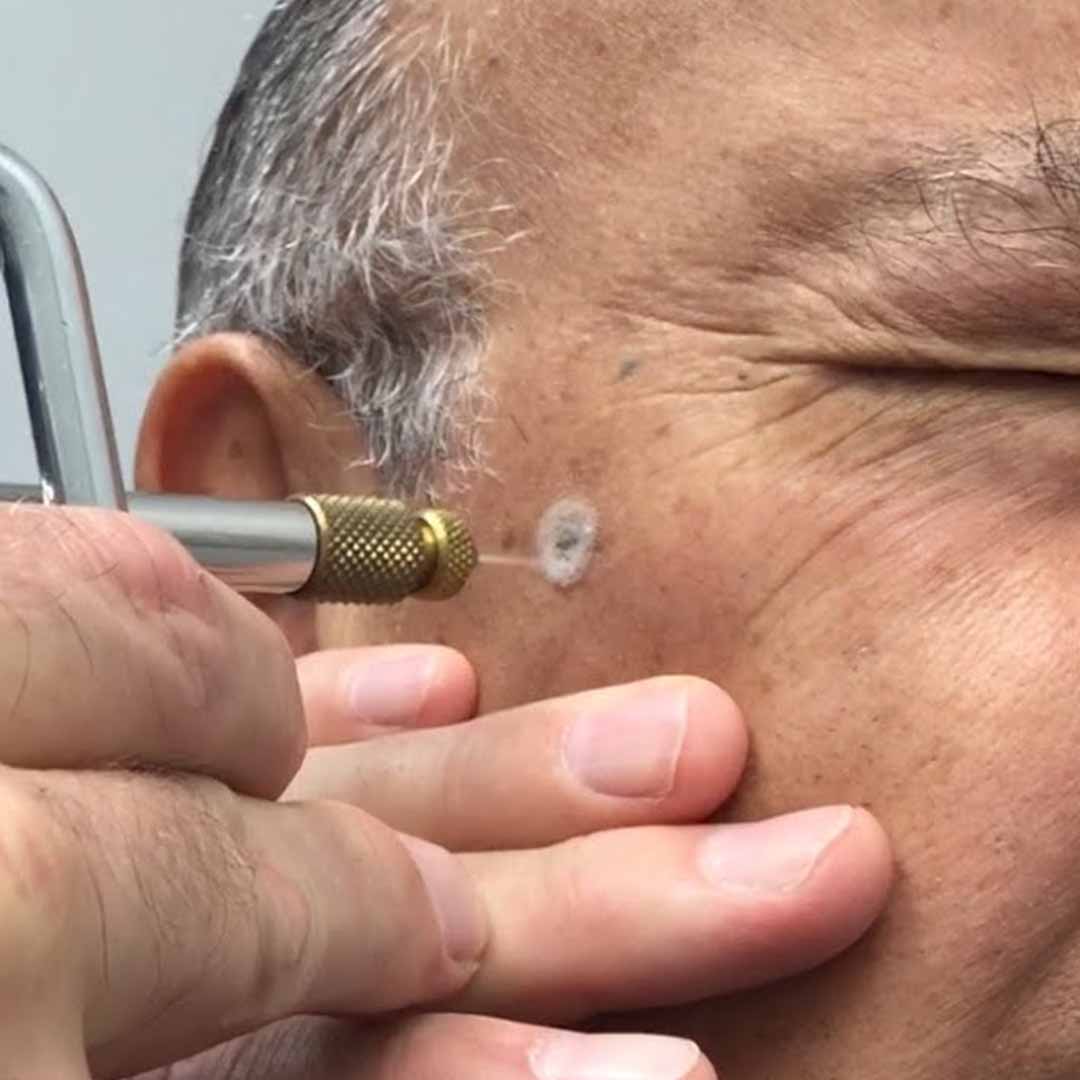 Seborrheic Keratosis Excision (3)
