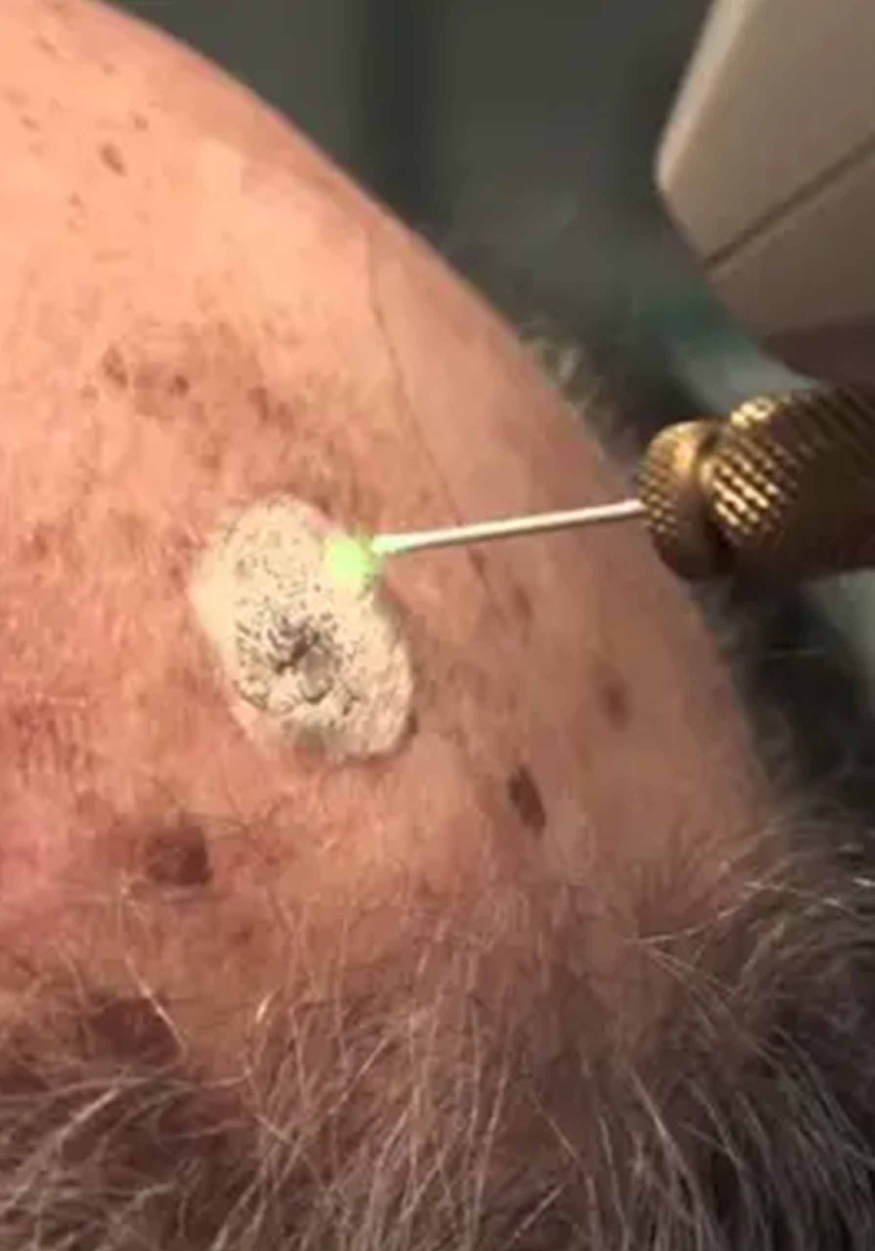 Seborrheic Keratosis Excision (4)