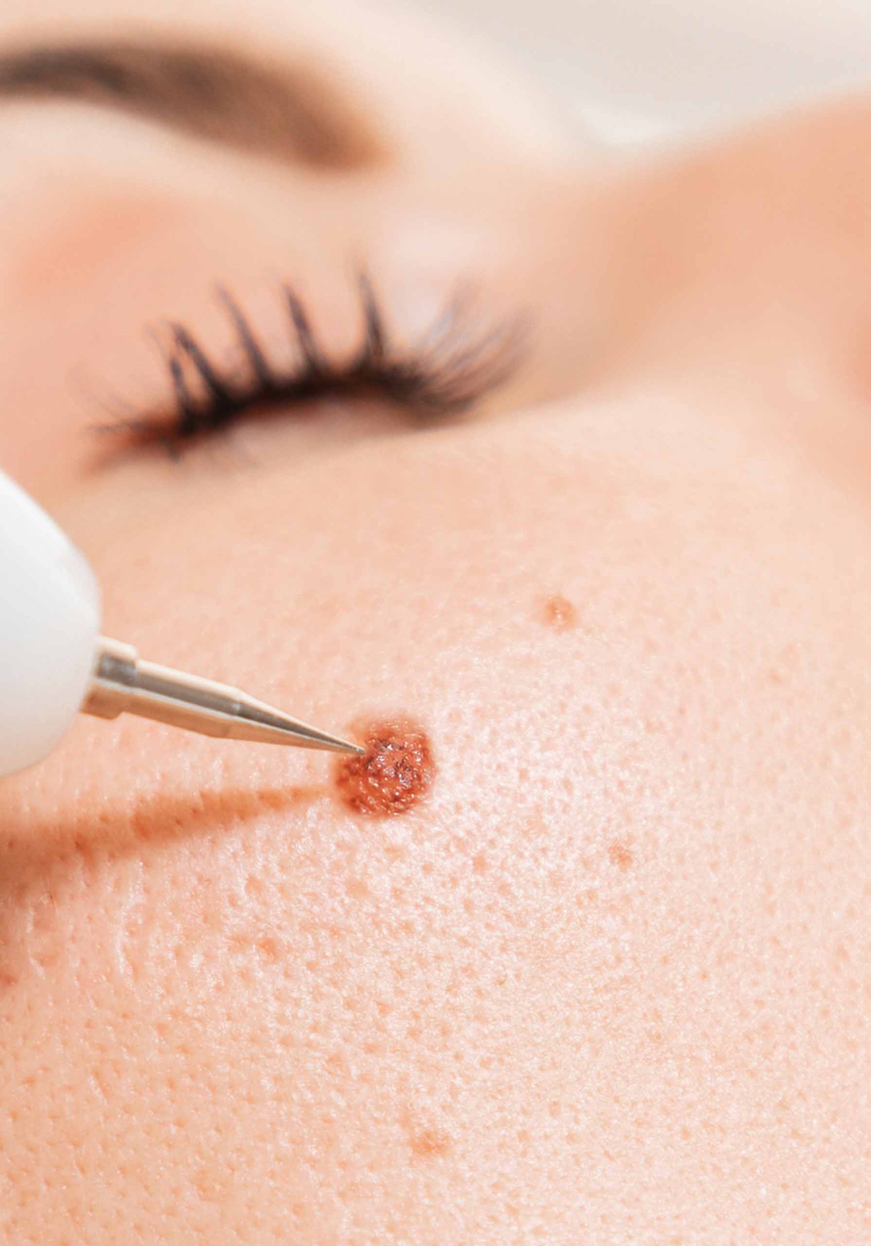 Wart Removal (3)