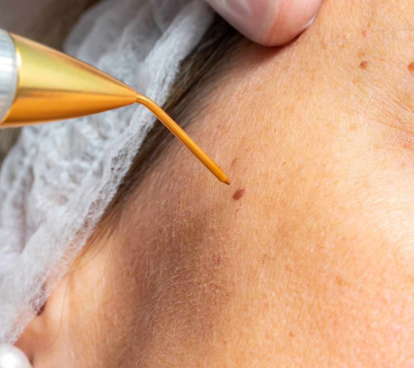 Wart Removal (4)