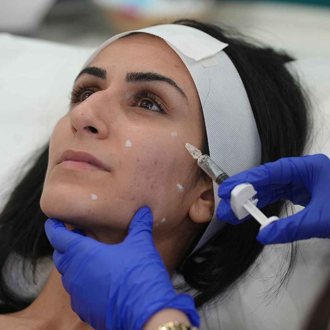 fillers (4)