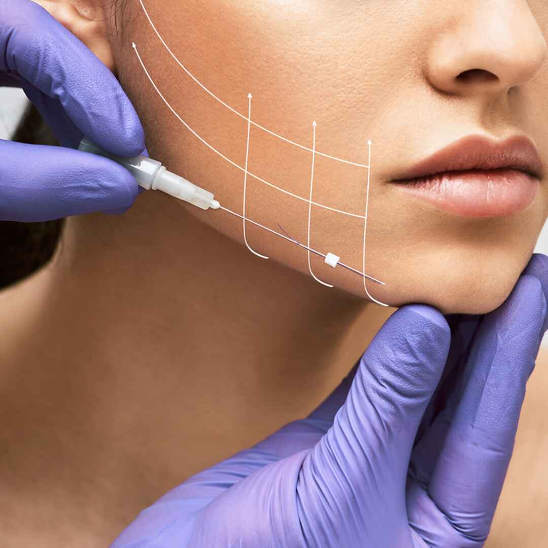thread lift (3)