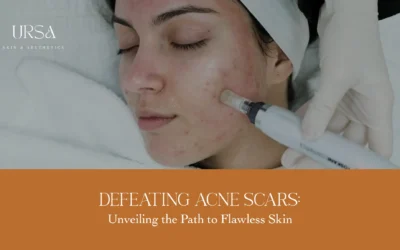 Defeat Acne Scars: Restore Flawless, Radiant Skin