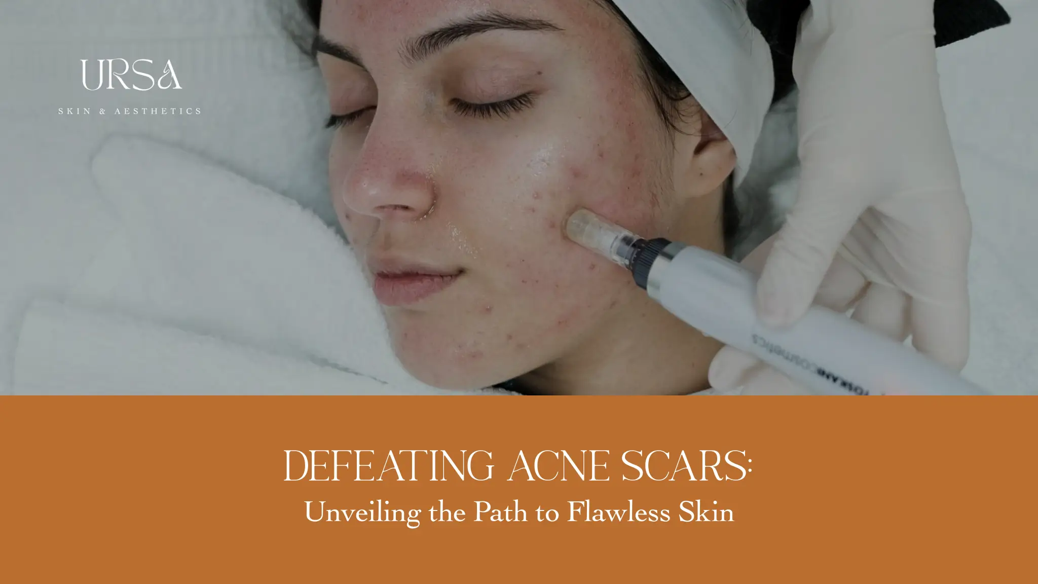 Acne Scars