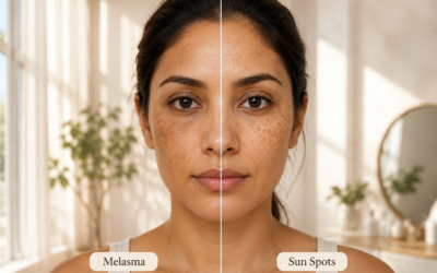 Blogs 10 Melasma vs Sun Spots: How to Tell the Difference (and Why Treatment Isn’t the Same)